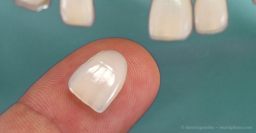 Wann Sind Veneers Medizinisch Notwendig